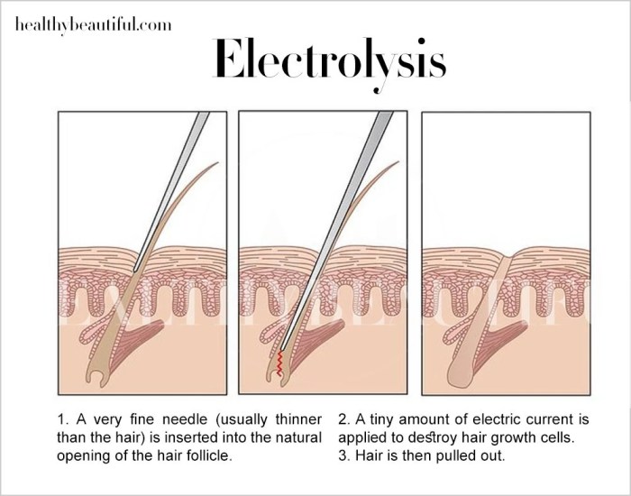 The most common form of temporary hair removal is